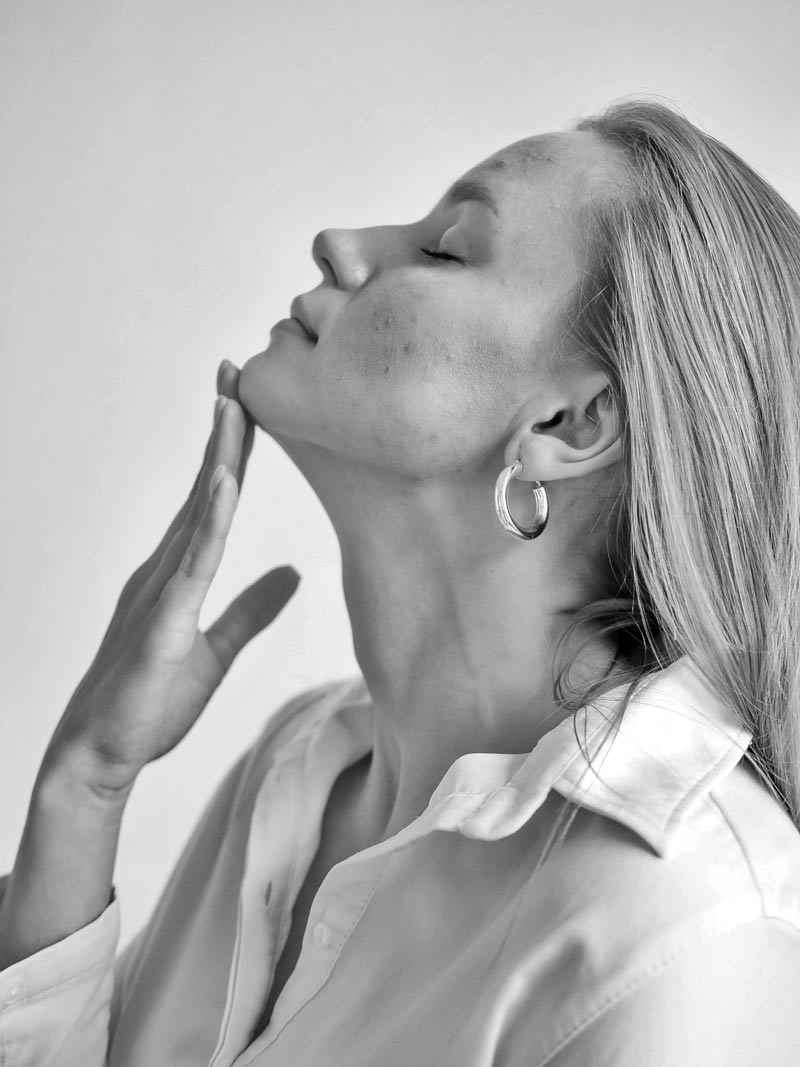 picture of a beautiful woman with acne on her skin