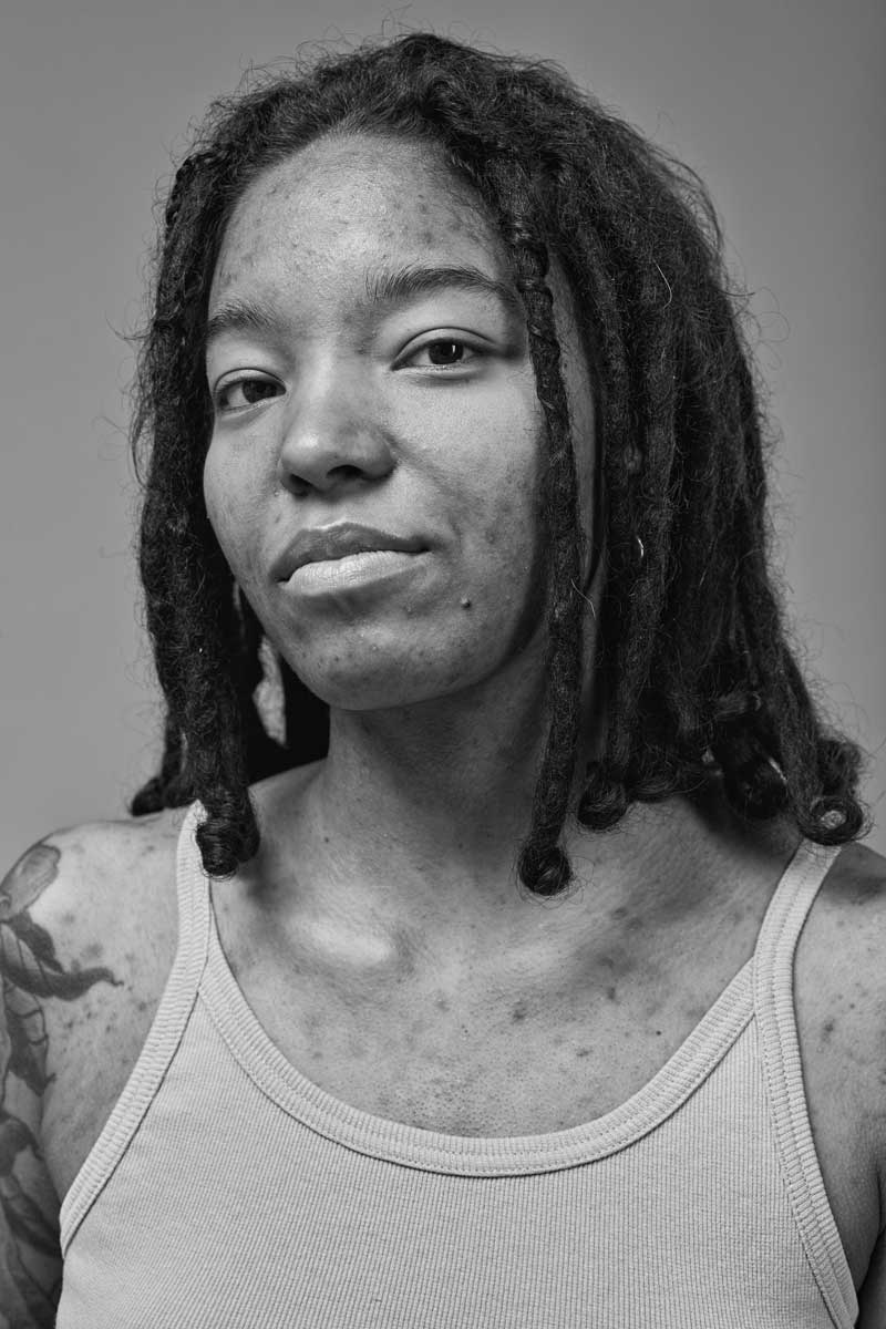 black young woman with no makeup and melasma skin concerns