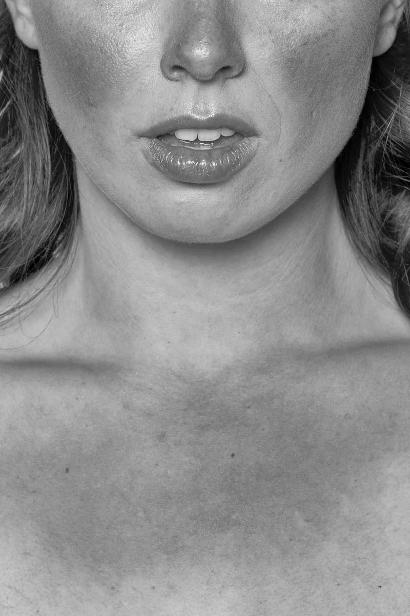 black and white picture of a topless woman with evident rosacea pigmentation of skin<br />
