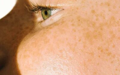 Top 3 Ingredients to Look for in Skincare Products for Melasma and Chloasma