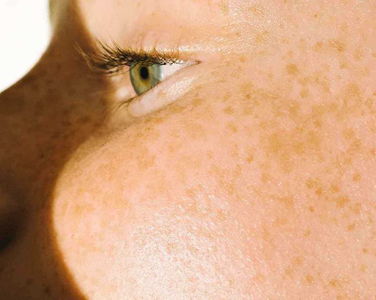 Cover image of the article Top 3 Ingredients to Look for in Skincare Products for Melasma and Chloasma showing a woman with chloasma symptoms