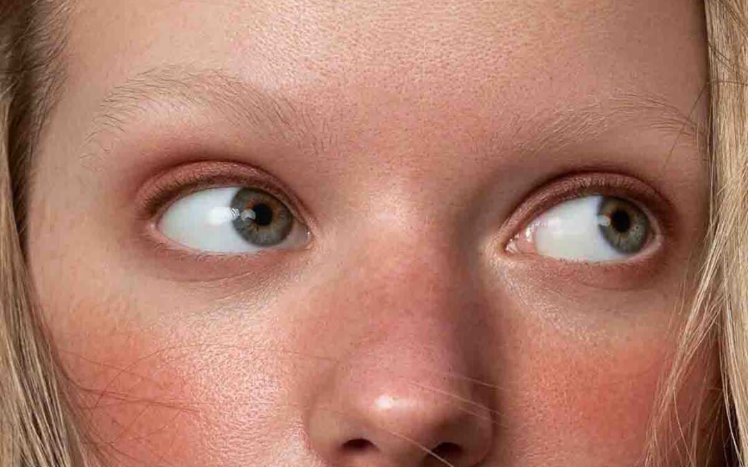 Cover image of the article 10 Natural Remedies for Rosacea: What Works, showing a young woman with rosacea symptoms