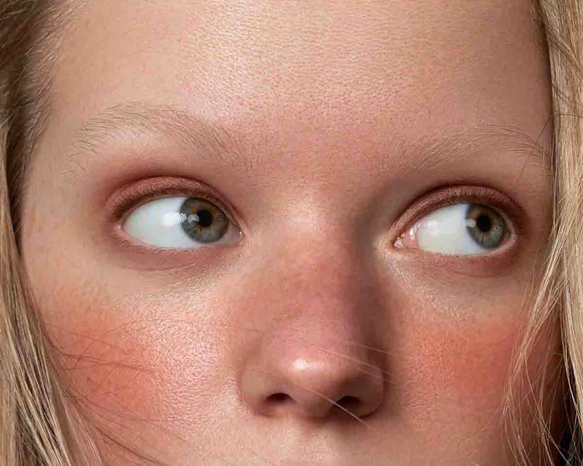 Cover image of the article 10 Natural Remedies for Rosacea: What Works, showing a young woman with rosacea symptoms