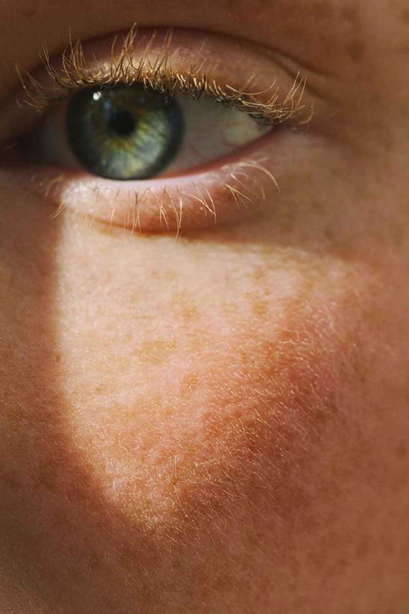 picture of a young woman showing mild melasma symptoms
