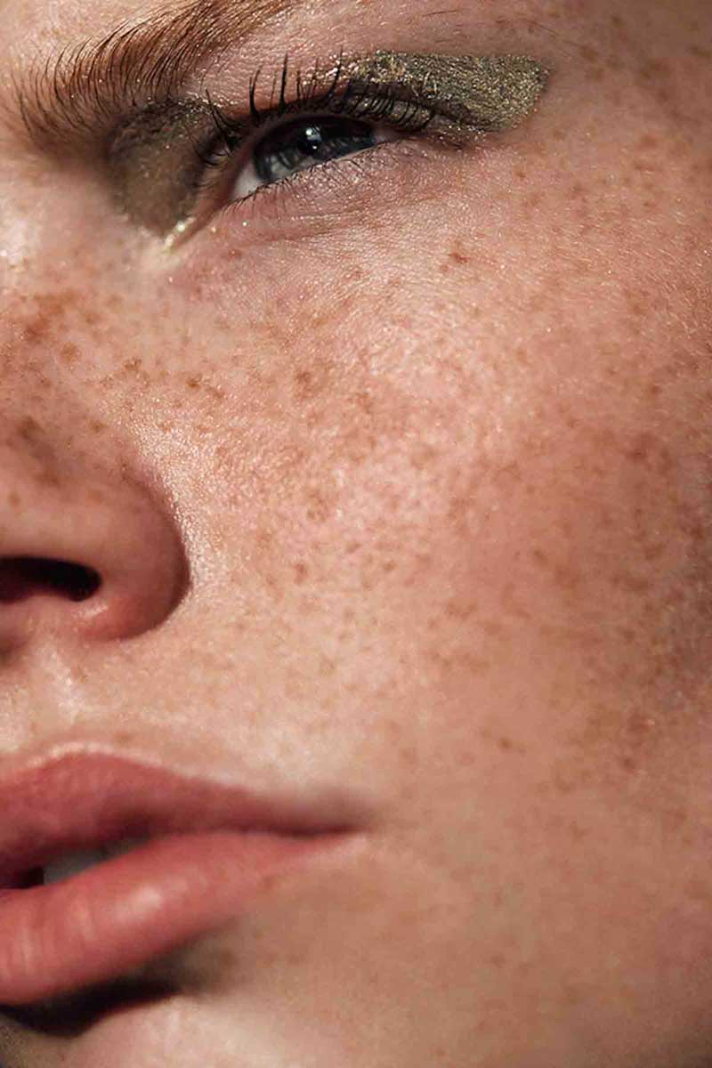 picture of a woman showing the symptoms of melasma