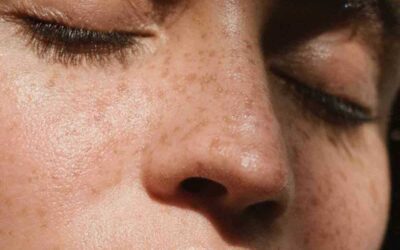 Understanding the Causes of Melasma: A Guide to Hormones, Sun Exposure and Genetics