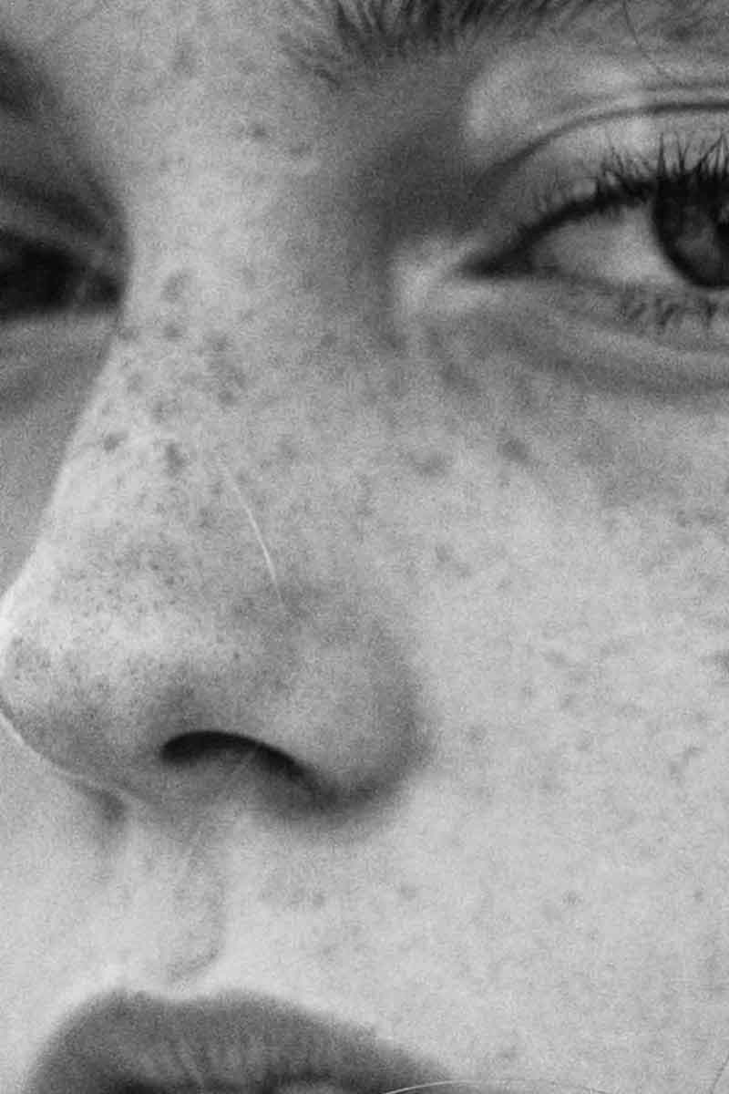 black and white picture of a girl with freckles and dark circles