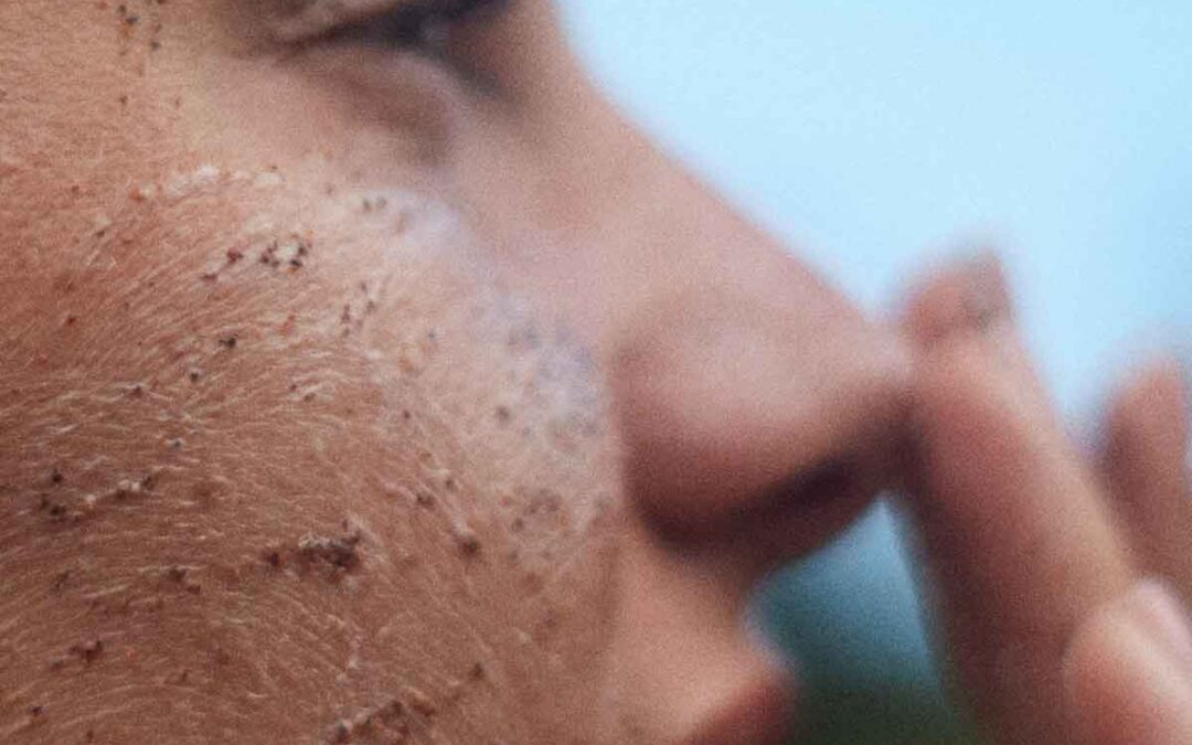 Enzymatic Exfoliation for Brighter, Smoother Skin